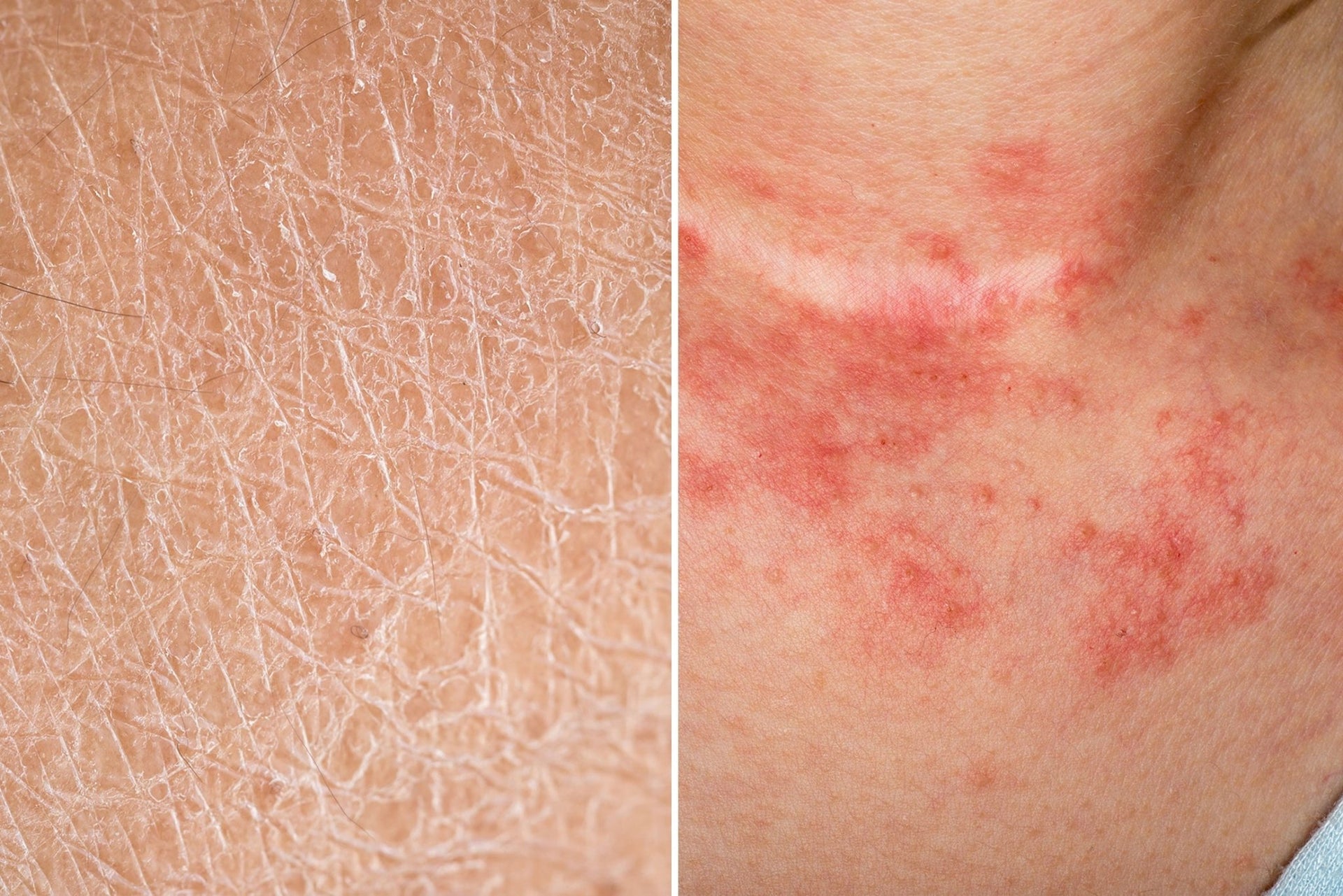 Eczema Uncovered - SONOCOUTURE