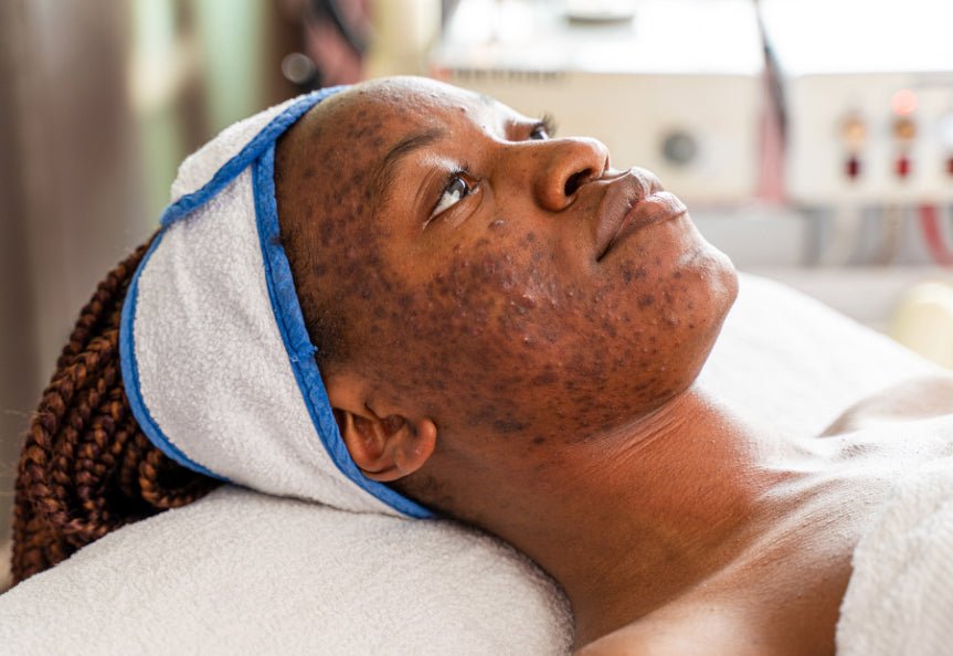 Understanding Post-Inflammatory Hyperpigmentation - SONOCOUTURE