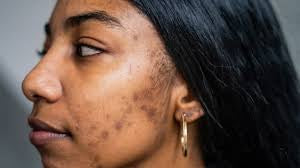 Acne and Acne scarring