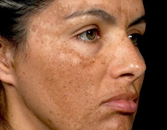 Melasma unveiled conquering dark spots